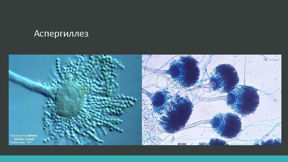 Аспергиллез 