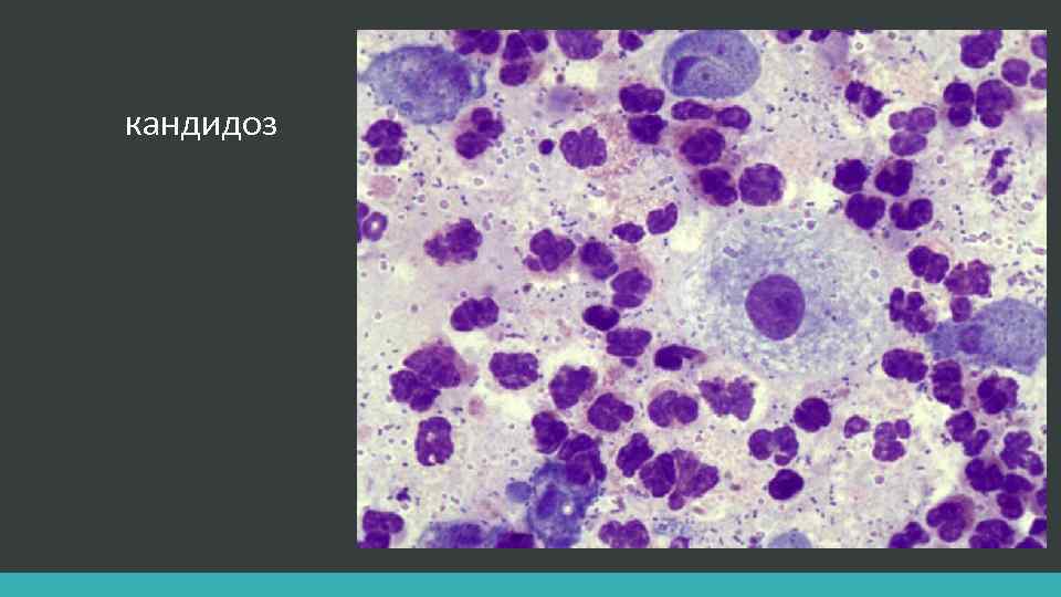 кандидоз 
