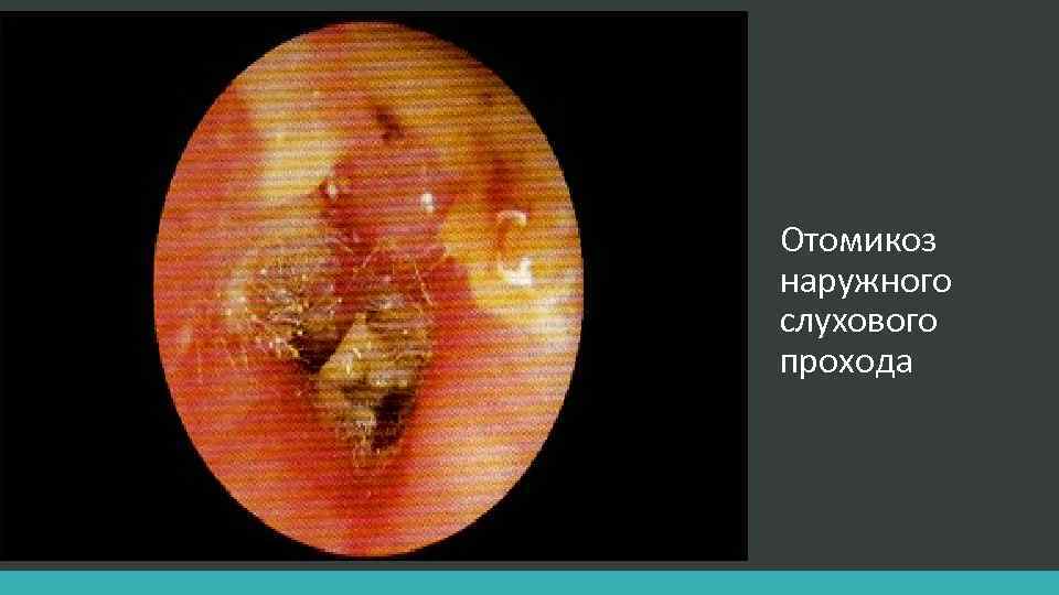 Отомикоз наружного слухового прохода 