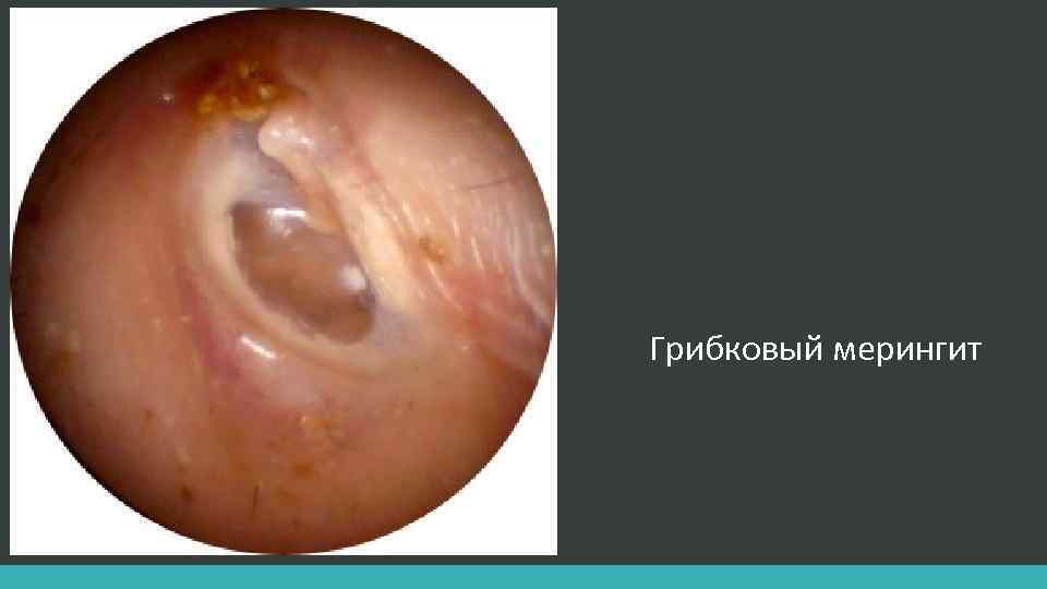 Грибковый мерингит 