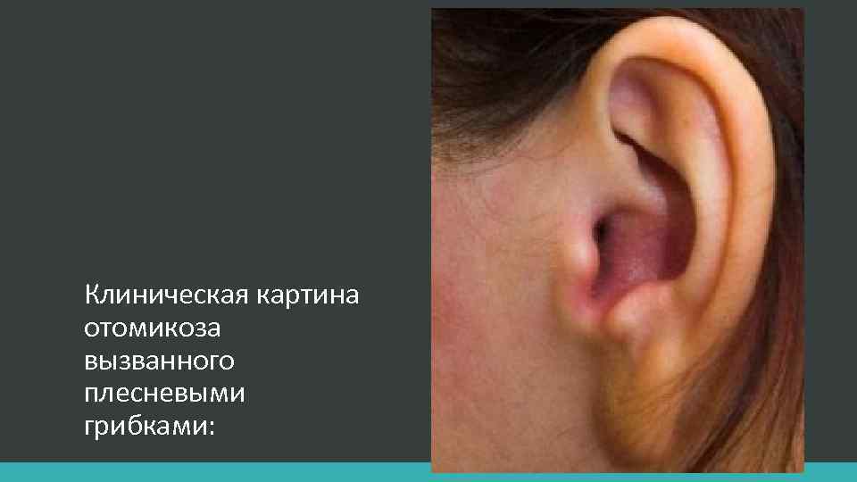 Клиническая картина отомикоза вызванного плесневыми грибками: 
