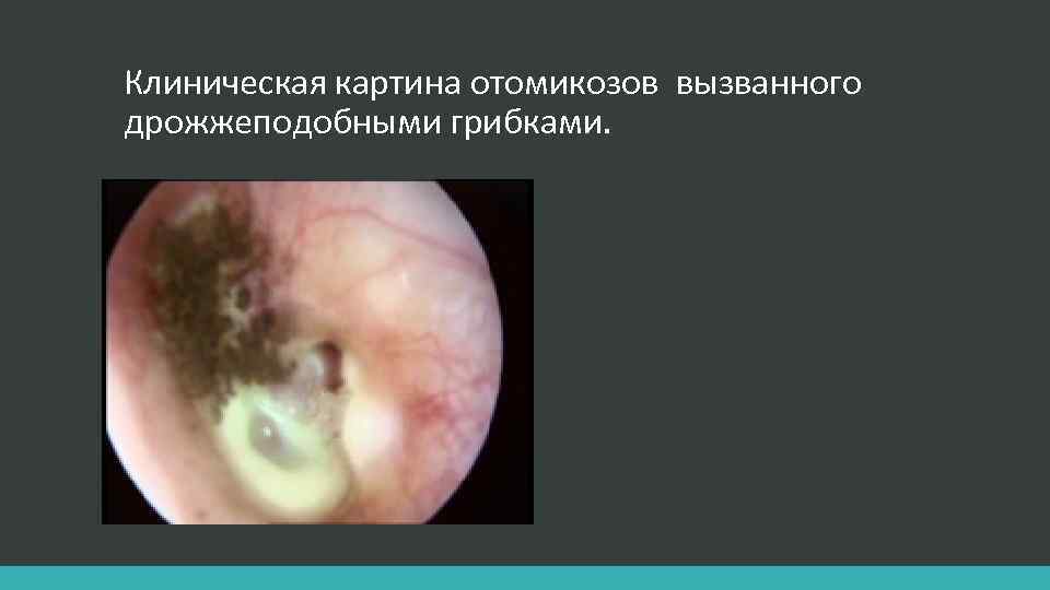 Клиническая картина отомикозов вызванного дрожжеподобными грибками. 