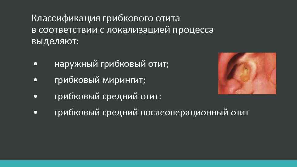 Классификация грибкового отита в соответствии с локализацией процесса выделяют: • наружный грибковый отит; •