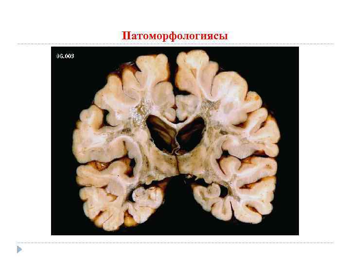 Патоморфологиясы 
