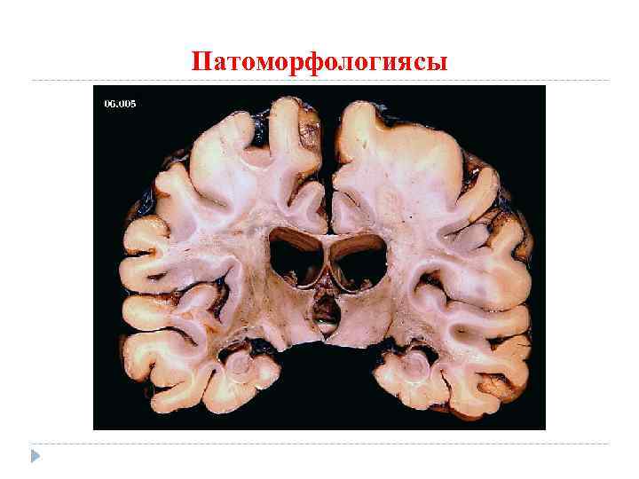 Патоморфологиясы 