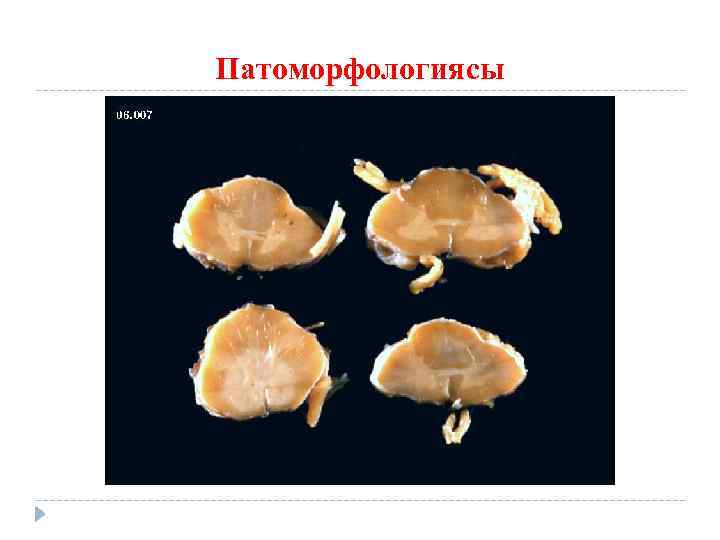 Патоморфологиясы 