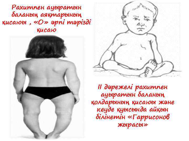 Рахитпен ауыратын баланың аяқтарының қисаюы , «О» әрпі тәрізді қисаю ІІ дәрежелі рахитпен ауыратын