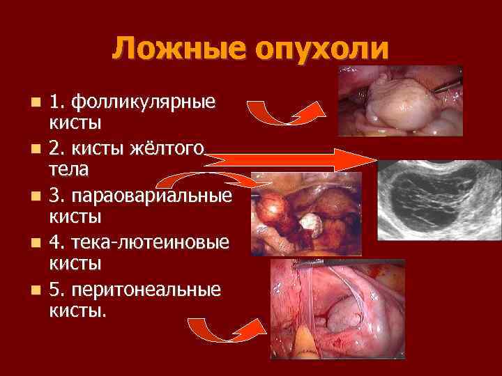 Ложные опухоли 1. фолликулярные кисты 2. кисты жёлтого тела 3. параовариальные кисты 4. тека