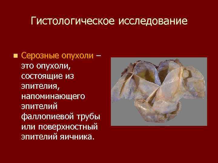 Гистологическое исследование Серозные опухоли – это опухоли, состоящие из эпителия, напоминающего эпителий фаллопиевой трубы