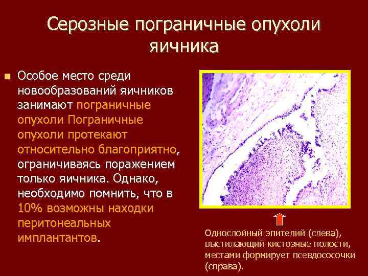 Пограничные опухоли яичников. Серозная пограничная опухоль