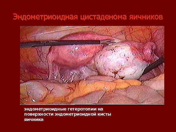 Эндометриоидная цистаденома яичников эндометриоидные гетеротопии на поверхности эндометриоидной кисты яичника 