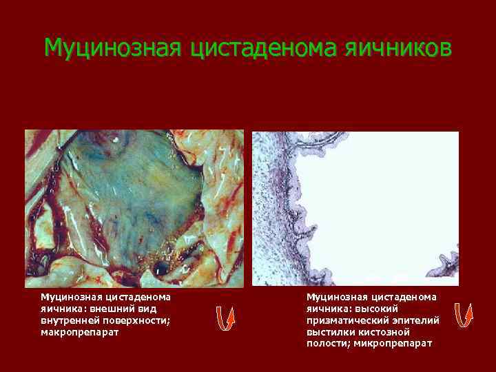 Муцинозная цистаденома яичников Муцинозная цистаденома яичника: внешний вид внутренней поверхности; макропрепарат Муцинозная цистаденома яичника: