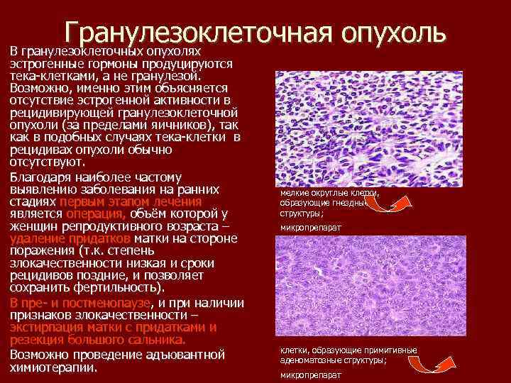 Гранулезоклеточная опухоль В гранулезоклеточных опухолях эстрогенные гормоны продуцируются тека клетками, а не гранулезой. Возможно,