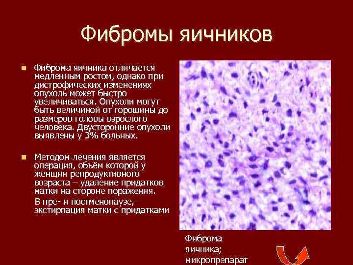 Фибромы яичников Фиброма яичника отличается медленным ростом, однако при дистрофических изменениях опухоль может быстро