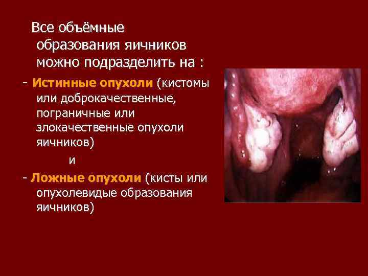 Все объёмные образования яичников можно подразделить на : Истинные опухоли (кистомы или доброкачественные, пограничные