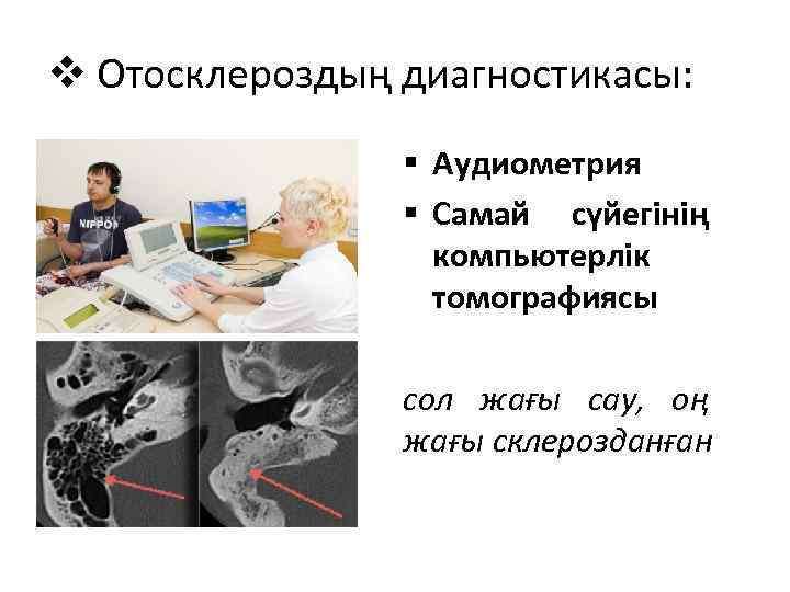 v Отосклероздың диагностикасы: § Аудиометрия § Самай сүйегінің компьютерлік томографиясы сол жағы сау, оң