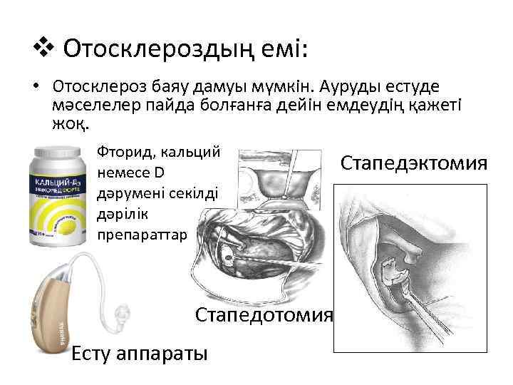 v Отосклероздың емі: • Отосклероз баяу дамуы мүмкін. Ауруды естуде мәселелер пайда болғанға дейін