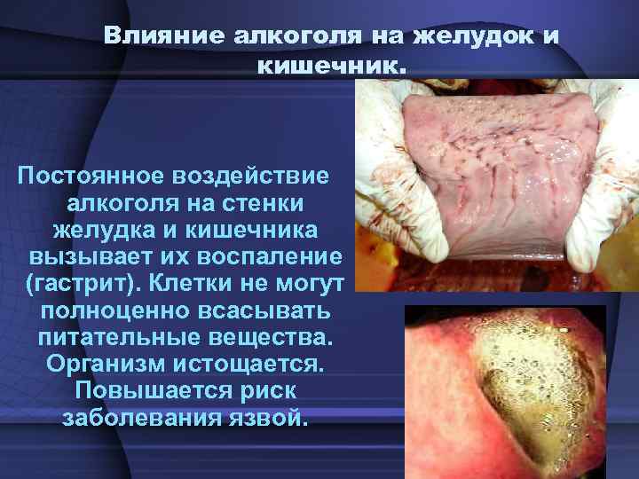 Влияние алкоголя на желудок и кишечник. Постоянное воздействие алкоголя на стенки желудка и кишечника