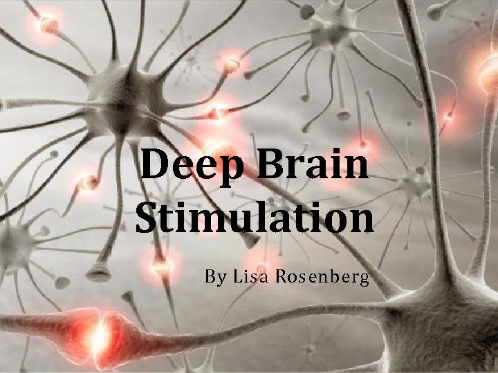 Deep Brain Stimulation By Lisa Rosenberg 