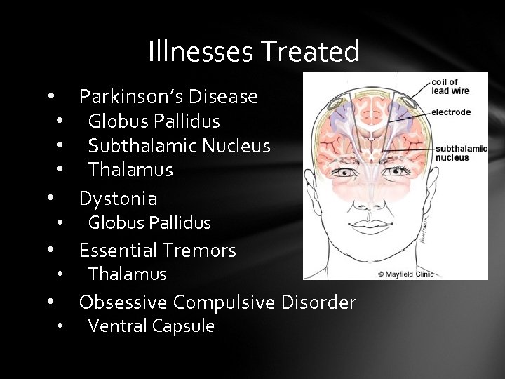 Illnesses Treated Parkinson’s Disease • Globus Pallidus • Subthalamic Nucleus • Thalamus • Dystonia