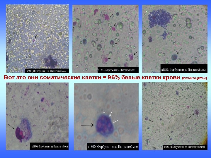 Вот это они соматические клетки = 96% белые клетки крови (лейкоциты) 