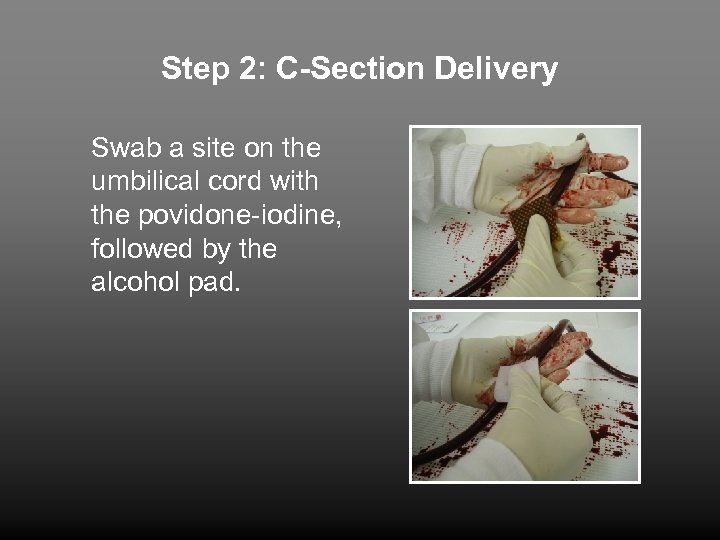 Step 2: C-Section Delivery Swab a site on the umbilical cord with the povidone-iodine,