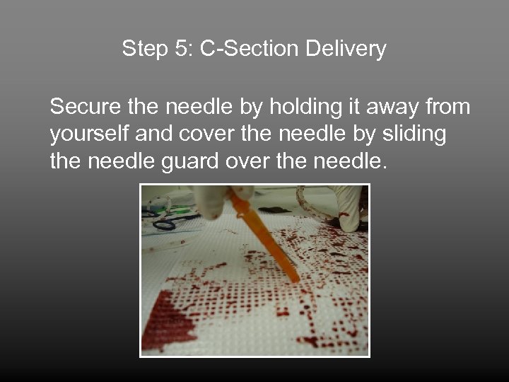 Step 5: C-Section Delivery Secure the needle by holding it away from yourself and