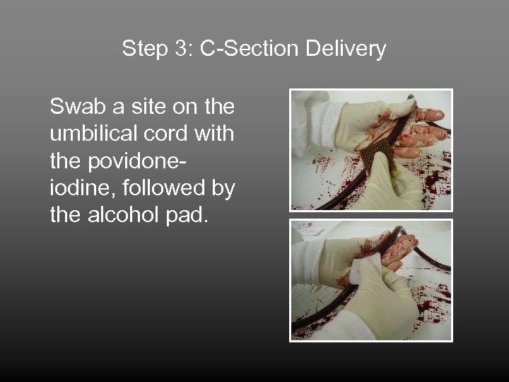 Step 3: C-Section Delivery Swab a site on the umbilical cord with the povidoneiodine,