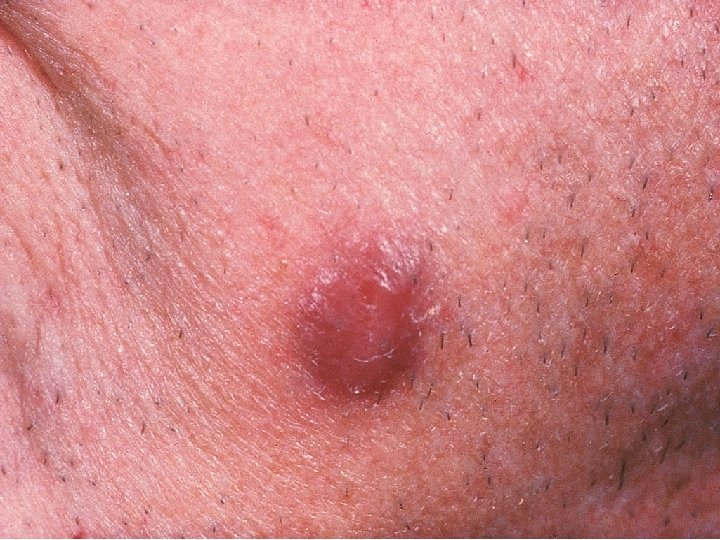 Skin Kaposi 