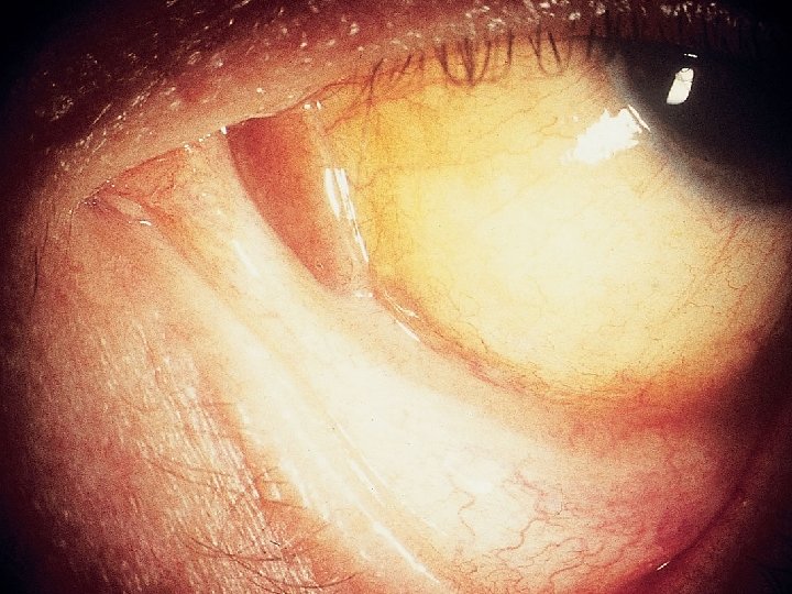 Conjunctival Kaposi 