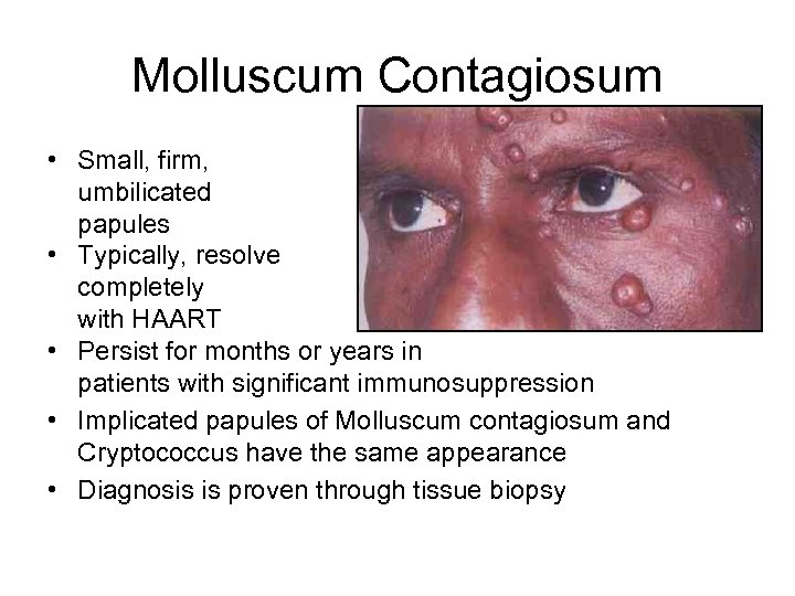 Molluscum Contagiosum • Small, firm, umbilicated papules • Typically, resolve completely with HAART •