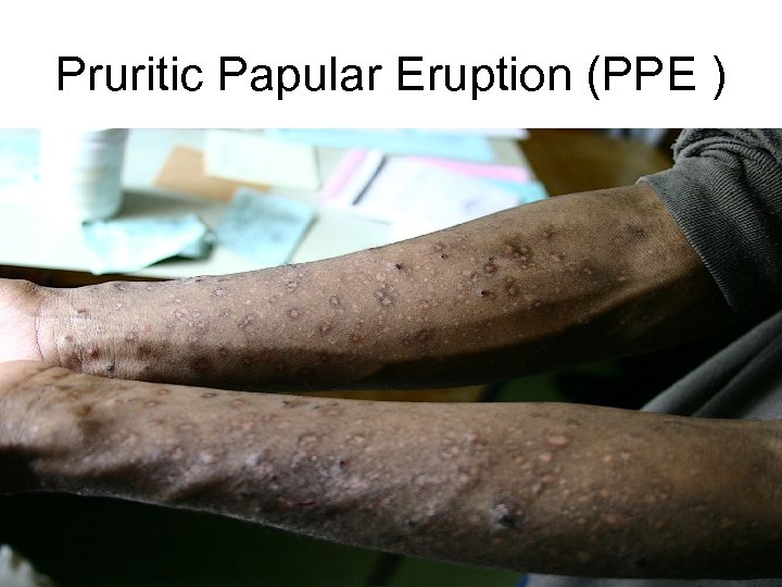 Pruritic Papular Eruption (PPE ) 