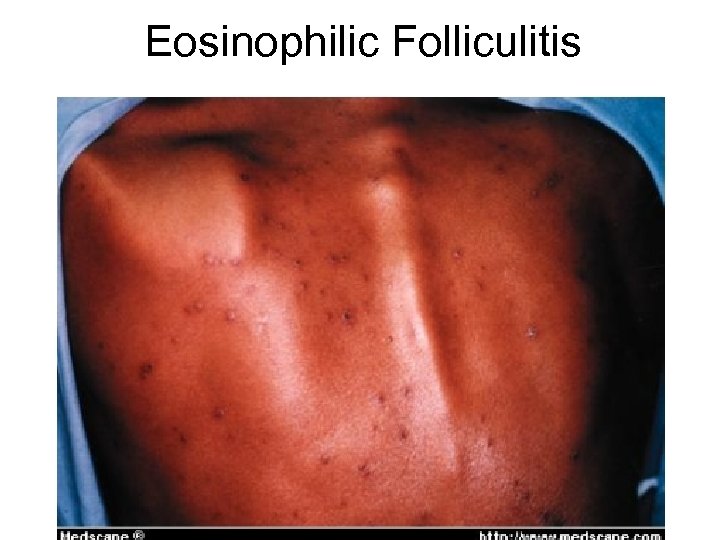 Eosinophilic Folliculitis 