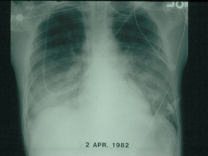 PCP Chest Radiograph 