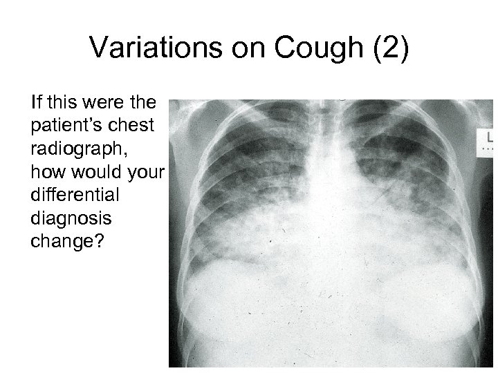 Variations on Cough (2) If this were the patient’s chest radiograph, how would your