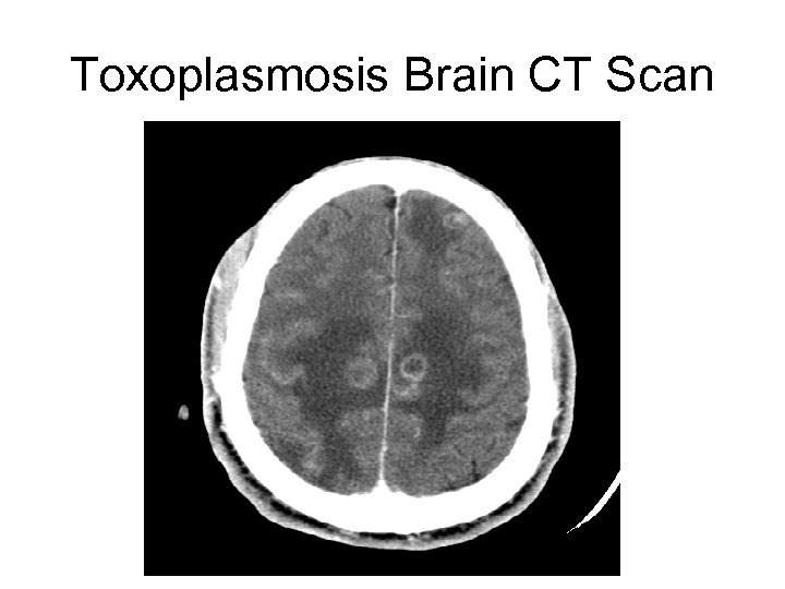 Toxoplasmosis Brain CT Scan 