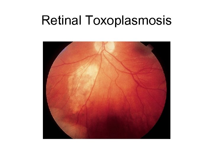 Retinal Toxoplasmosis 
