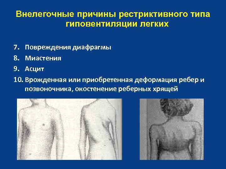 Внелегочные причины рестриктивного типа гиповентиляции легких 7. Повреждения диафрагмы 8. Миастения 9. Асцит 10.