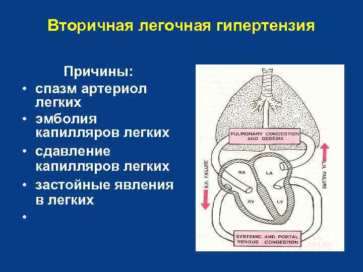 Вторичная легочная гипертензия • • • Причины: спазм артериол легких эмболия капилляров легких сдавление