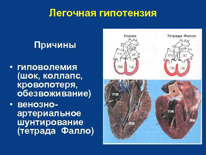 Легочная гипотензия Причины • гиповолемия (шок, коллапс, кровопотеря, обезвоживание) • венозноартериальное шунтирование (тетрада Фалло)