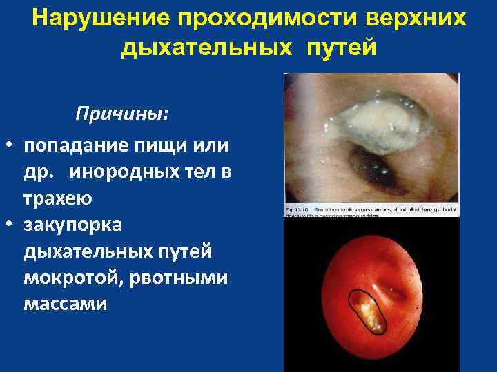 Нарушение проходимости верхних дыхательных путей Причины: • попадание пищи или др. инородных тел в
