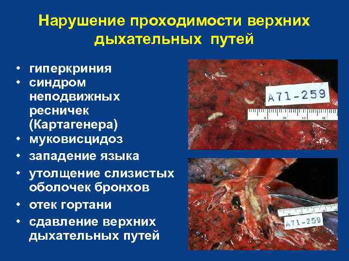 Нарушение проходимости верхних дыхательных путей • гиперкриния • синдром неподвижных ресничек (Картагенера) • муковисцидоз
