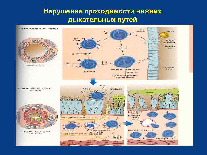 Нарушение проходимости нижних дыхательных путей 