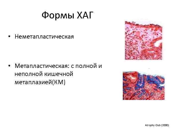 Формы ХАГ • Неметапластическая • Метапластическая: с полной и неполной кишечной метаплазией(КМ) Atrophy Club