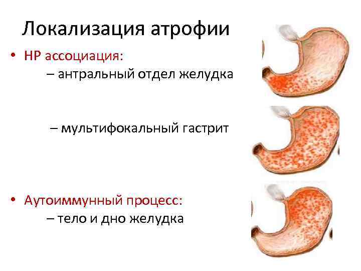 Локализация атрофии • НР ассоциация: – антральный отдел желудка – мультифокальный гастрит • Аутоиммунный