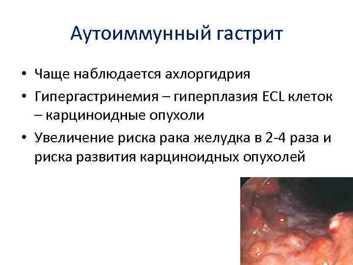 Аутоиммунный гастрит • Чаще наблюдается ахлоргидрия • Гипергастринемия – гиперплазия ECL клеток – карциноидные