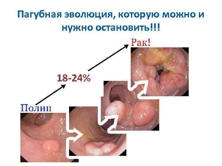 Пагубная эволюция, которую можно и нужно остановить!!! 18 -24% 