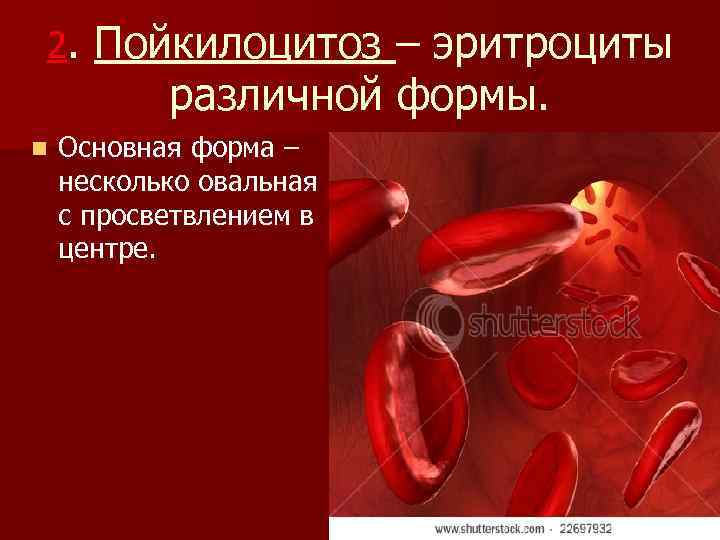 2. n Пойкилоцитоз – эритроциты различной формы. Основная форма – несколько овальная с просветвлением