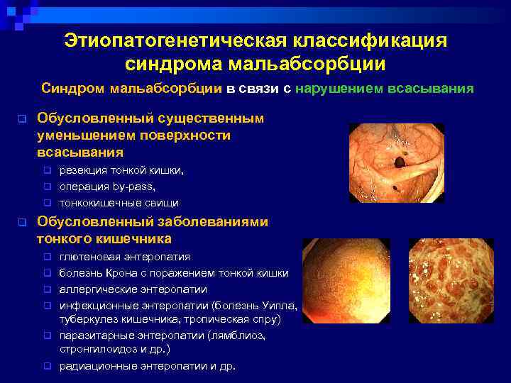 Этиопатогенетическая классификация синдрома мальабсорбции Синдром мальабсорбции в связи с нарушением всасывания q Обусловленный существенным