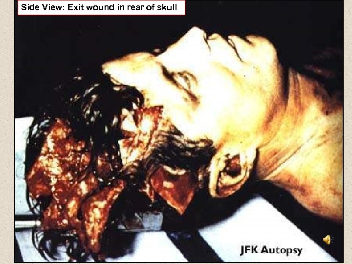 Side View: Exit wound in rear of skull 